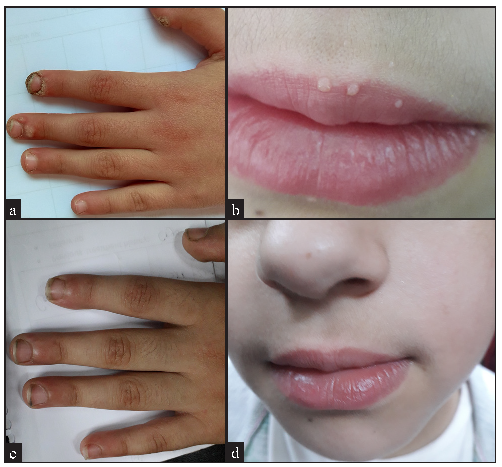 (a) A 10-year old girl in the MMR group with multiple common and periungual wartswarts, (before treatment), (b) Female patient aged 10 years in the vitamin MMR group with multiple common and periungual warts, (before treatment), (c) After three sessions of IL MMR with excellent response, (d) After three sessions of IL MMR with excellent response.