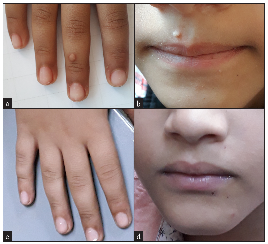 (a) A 6-year old boy with multiple common warts, (before treatment), (b) Male patient aged 6 years in the vitamin D group with multiple common warts, (before treatment), (c) A 6-year old boy with multiple common warts, (after treatment), (d) After 3 sessions of IL vitamin D with excellent response.