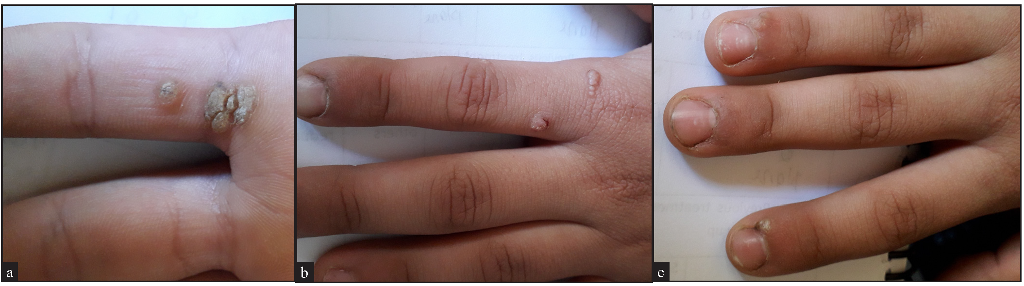 A 9-years old boy in the vitamin D group with multiple common and periungual warts, (before treatment).