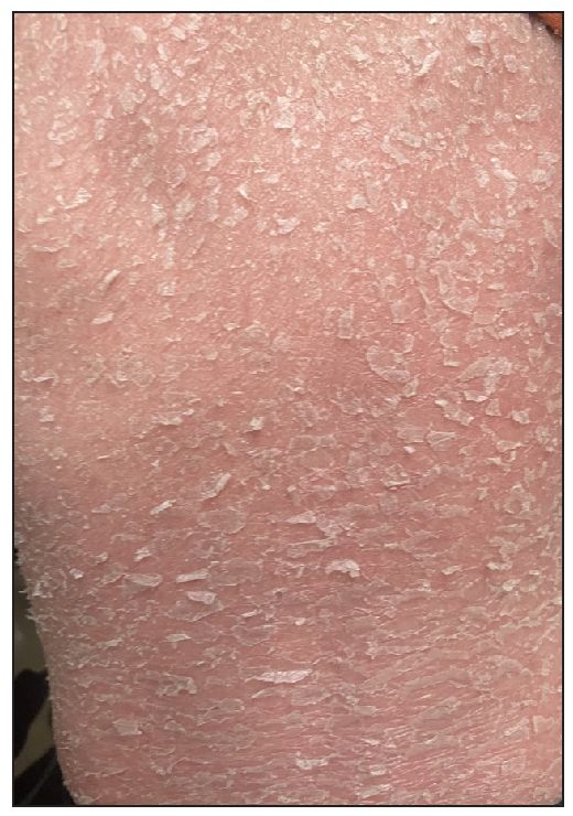 Erythroderma at 2 years of age with prominent erythema and scaling involving the trunk.