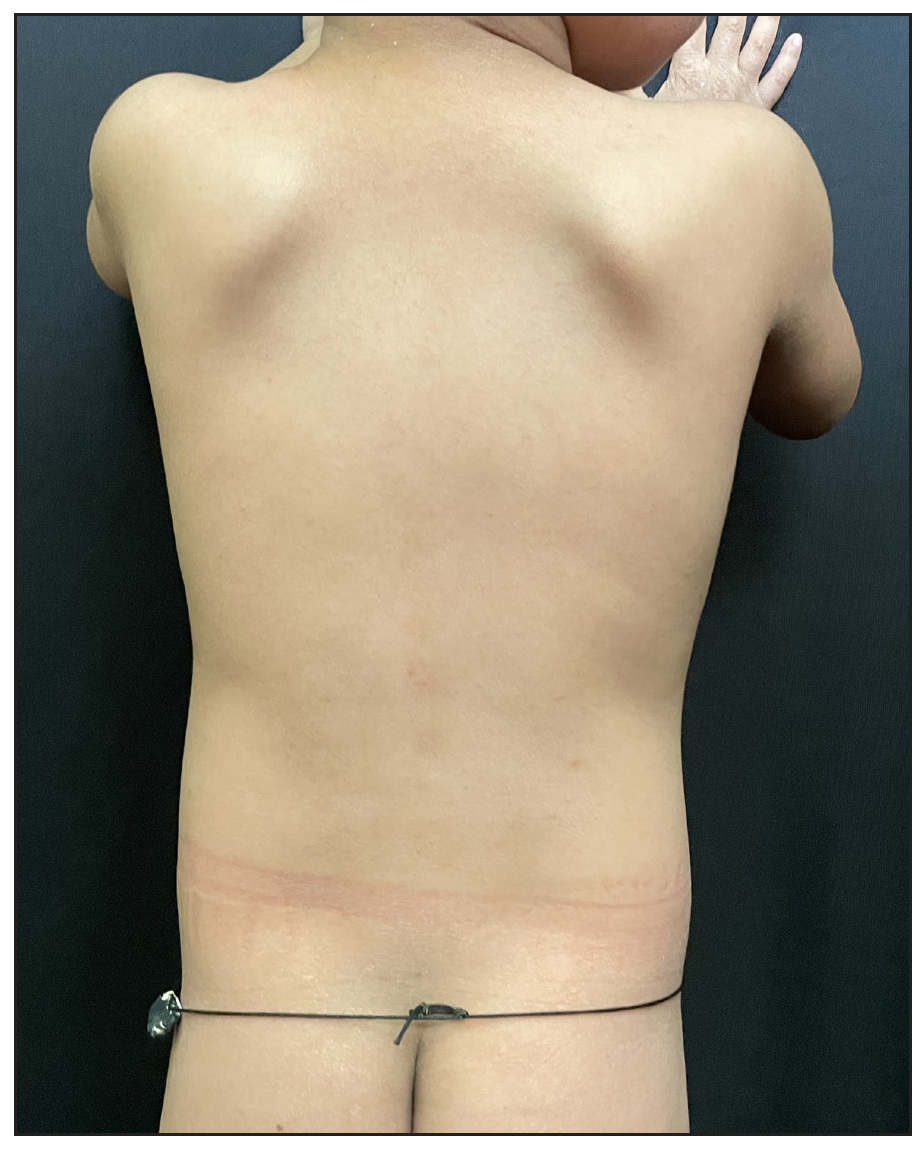 Complete clearance of skin over the trunk after 12 weeks of secukinumab.