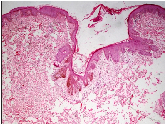 Histopathology showing downward slender elongation of pigmented rete pegs confined to the follicular epithelium (Haematoxylin and eosin, 400x).