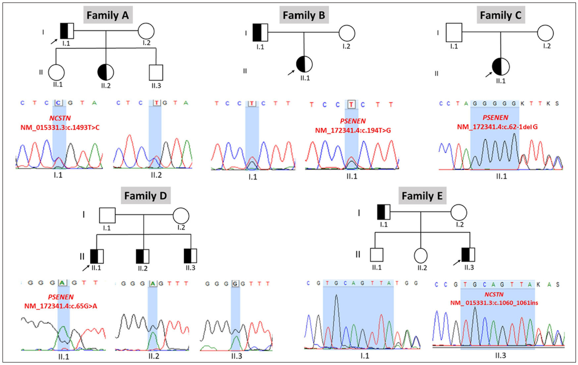 Sequence chromatograms depicting the identified pathogenic or likely pathogenic variants in PSENEN and NCSTN genes in the affected follicular DDD patients and their family members (arrows indicate proband).