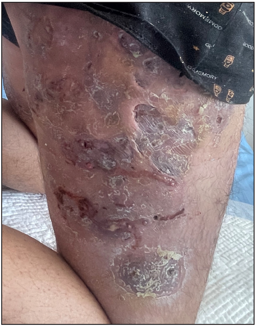 Skin lesions before treatment in patient 2.