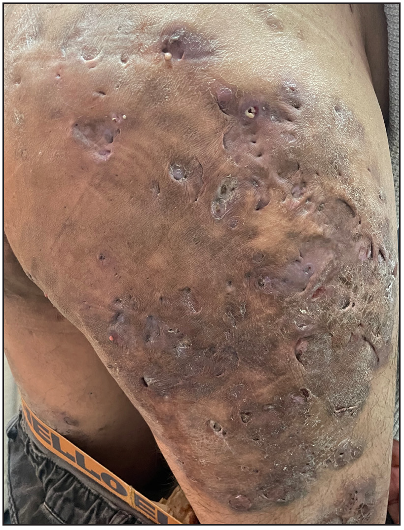 Skin lesions after treatment in patient 2.