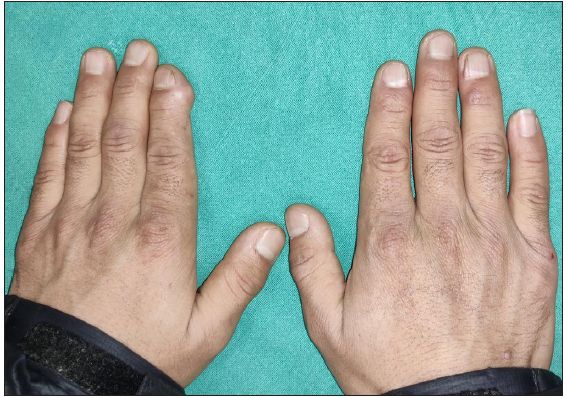 Clinical photograph showing subungual swelling in the distal phalanx of left 2nd finger.