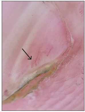 Onychoscopy showing a red-coral sign in which abundant tortuous dilated vessels, resembling red-coral with tentacle-like arms are dancing in the sea, seen in left 2nd finger nail (black arrow) (DermLite DL3N, contact, polarised, 10x).