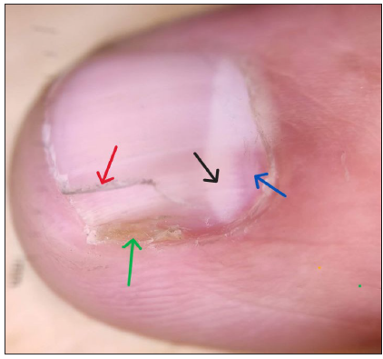 Onychoscopy showing triangular deformed lunula (black arrow) with red areas (blue arrow), onycholysis (green arrow) and onychorrhexis (red arrow) in the right 2nd finger nail (DermLite DL3N, contact, polarised, 10x).