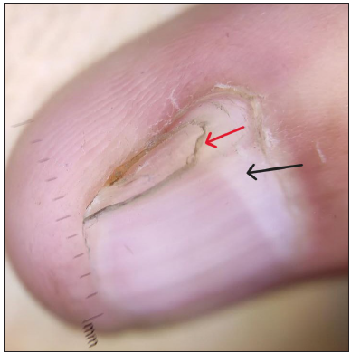 Onychoscopy showing triangular deformed lunula (black arrow) and onychorrhexis (red arrow) in right 4th finger nail (DermLite DL3N, contact, polarised, 10x).