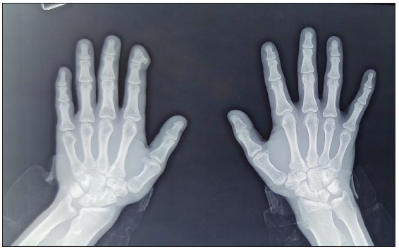 X-ray showing osteochondromas on the left 2nd distal phalanx, right 2nd and 4th distal phalanx and left 1st metacarpal, with characteristic coat-hanger sign.