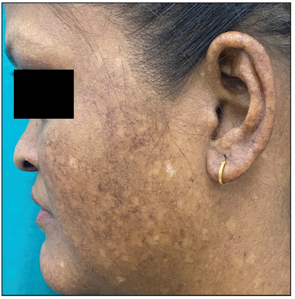 Multiple ill-defined hypopigmented atrophic macules on a background of reticular hyperpigmentation on left cheek and pinna with partial loss of eyebrow.