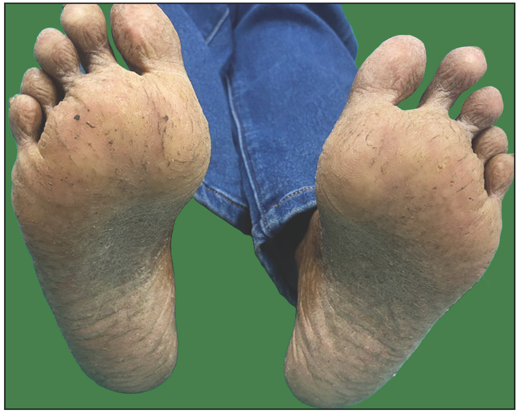 Clinical image of the patient showing plantar keratoderma.