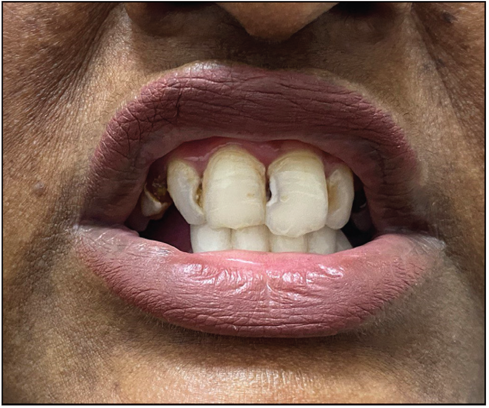 Clinical image of the oral cavity showing peg-shaped teeth.