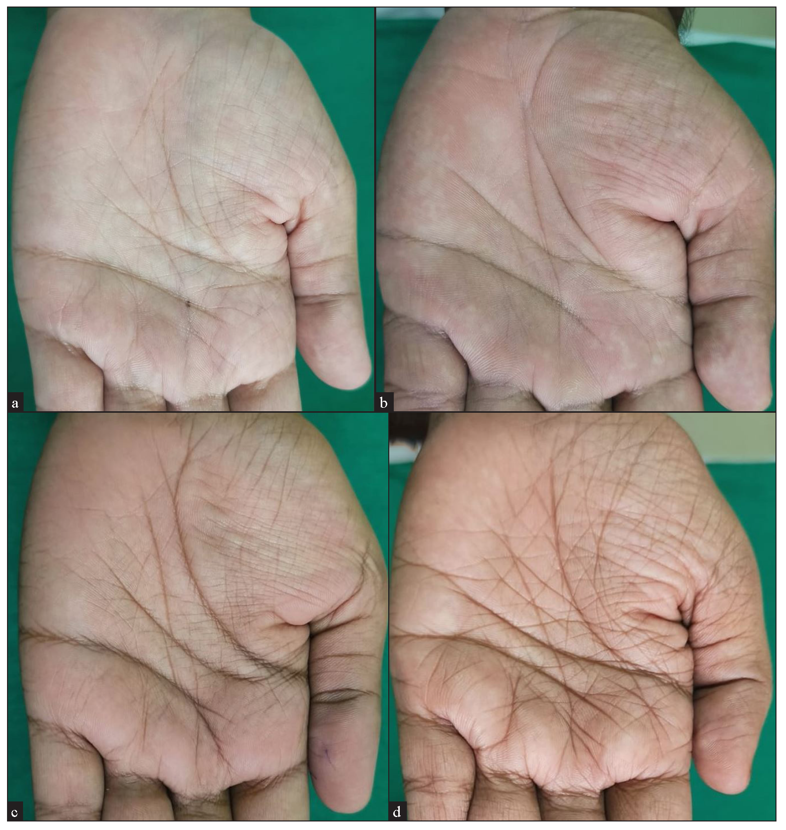 Palmar hyperlinearity patterns. (a) Pattern 1: Fine perpendicular lines. (b) Pattern 2: Fine crosshatch. (c) Pattern 3: Extensive crosshatch. (d) Pattern 5: Prominent diamond-shaped hyperlinearity.