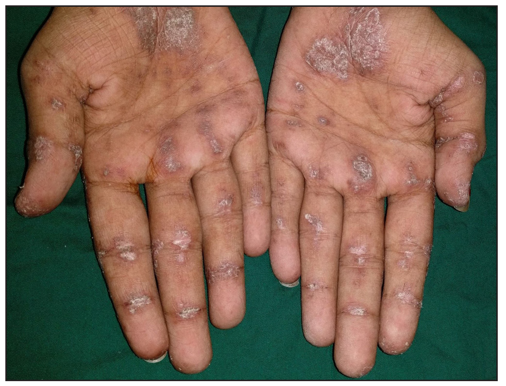 Multiple erythematous, raised, scaly papules localised over the palmar creases of the interphalangeal joints on both hands, characteristic of inverse Gottron papules.