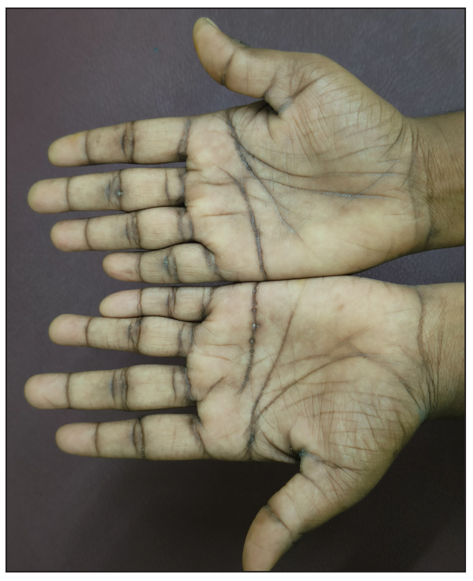 Hyperkeratotic pits over the palmar creases predominantly localised to the distal palmar crease of the left hand in a 15-year-old girl, suggestive of keratosis punctata of the palmar creases.