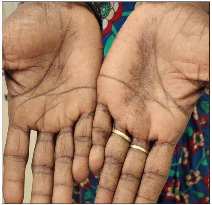 Diffuse hyperpigmentation of the palmar creases in a patient with Addison disease, predominantly affecting the creases.