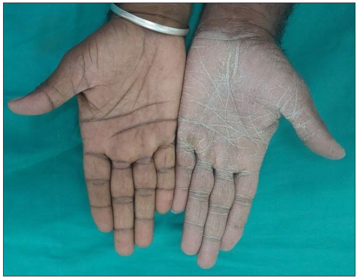 Unilateral tinea manuum with scales more pronounced over the palmar creases.