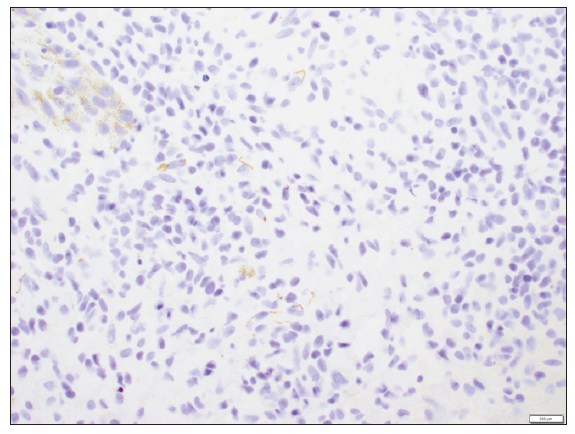 Immunohistochemistry stained multiple spirochetes, visualised as brown filamentous and coiled figures, at 40x magnification.