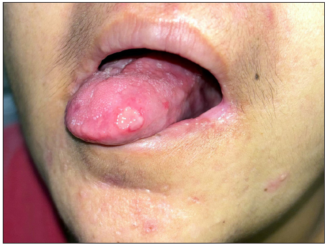 Major aphthous ulcer on the tongue.