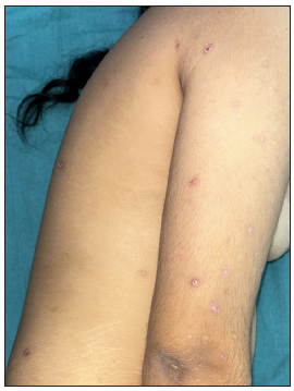 Multiple erythematous papules and pustules on upper extremities and the trunk.