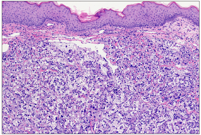 Histopathology showing polygonal and cuboidal cells of varying sizes in the dermis with clear cytoplasm (Haematoxylin-eosin; 20x).