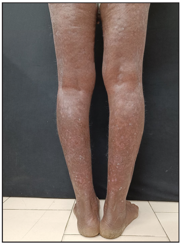 Reduction to psoriasis area and severity index 4, 12 weeks after reinduction with secukinumab.