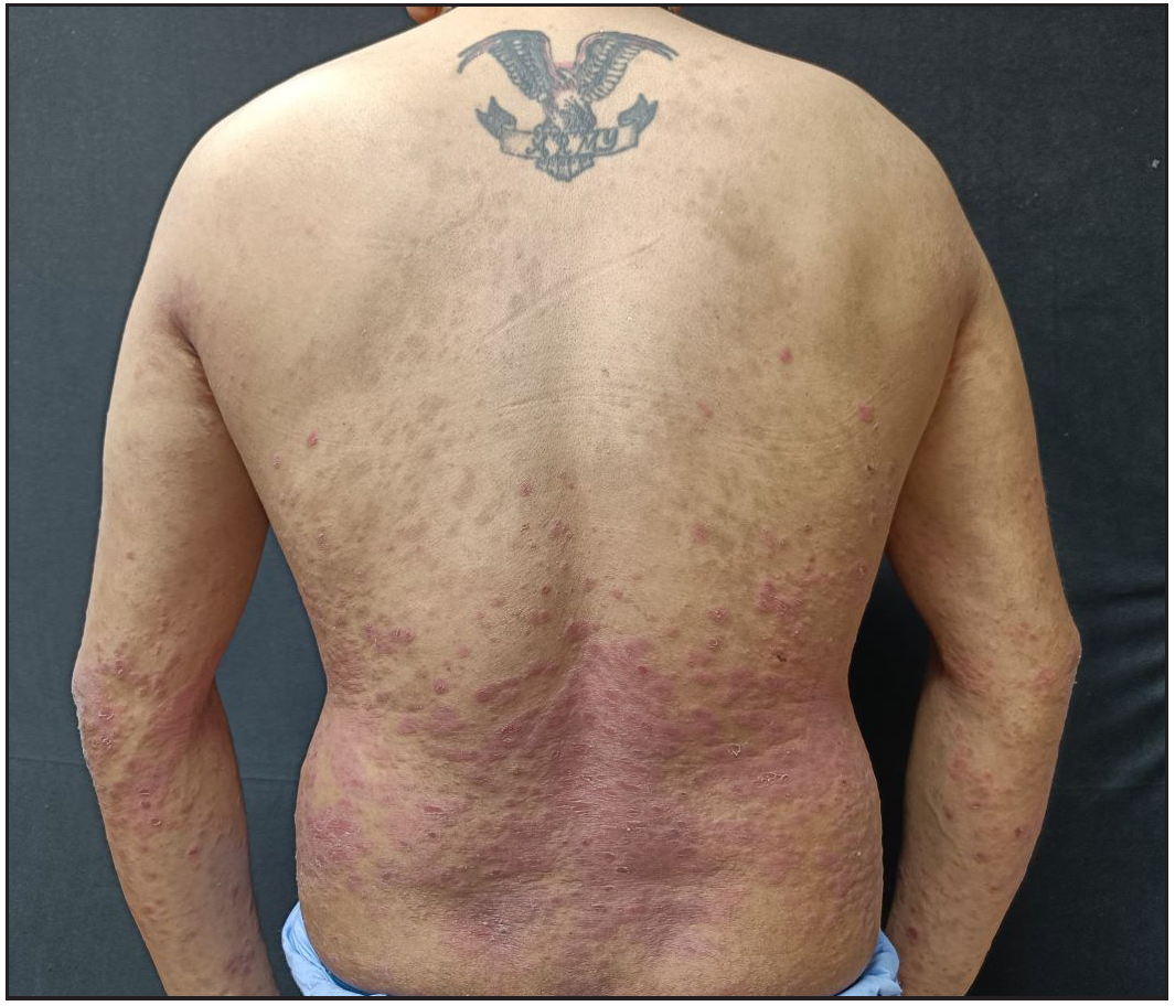Secondary failure in a patient on secukinumab presenting with 70% body surface area involvement.