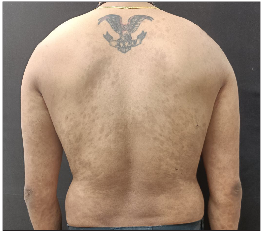 Clearance of skin lesions 8 weeks after reinduction.
