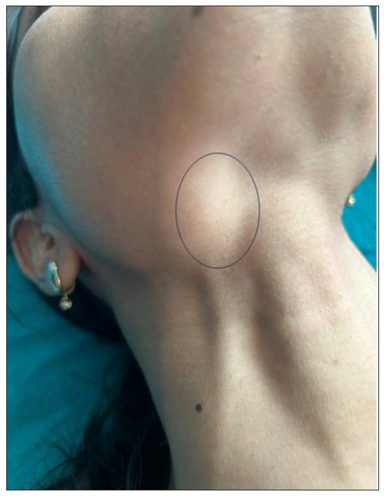 Lymphadenopathy became more prominent on deglutition as marked by a black circle.