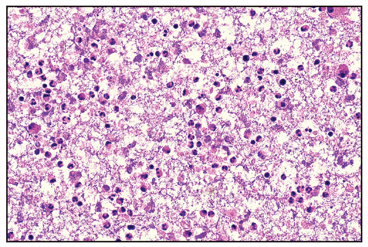 Fine needle aspiration cytology (FNAC) of affected lymph node shows moderate cellularity with acute on chronic inflammatory infiltrate comprising of polymorphous population of small mature lymphocytes, plasma cells, few neutrophils and eosinophils along with lympho-histiocytic tangles and capillary strands in a necrotic background. Karyorrhectic and calcific debris and RBCs seen (Haematoxylin and eosin, 40x).
