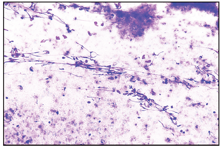 Moderate cellularity with acute on chronic inflammation in a necrotic background. Few histiocytes and necrotic granular material also seen (Giemsa, 20x).