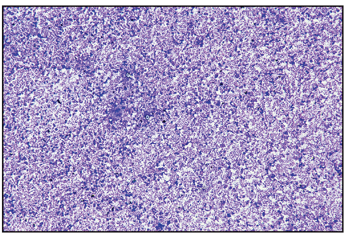 Necrotic granular material along with inflammation (Giemsa, 10x)