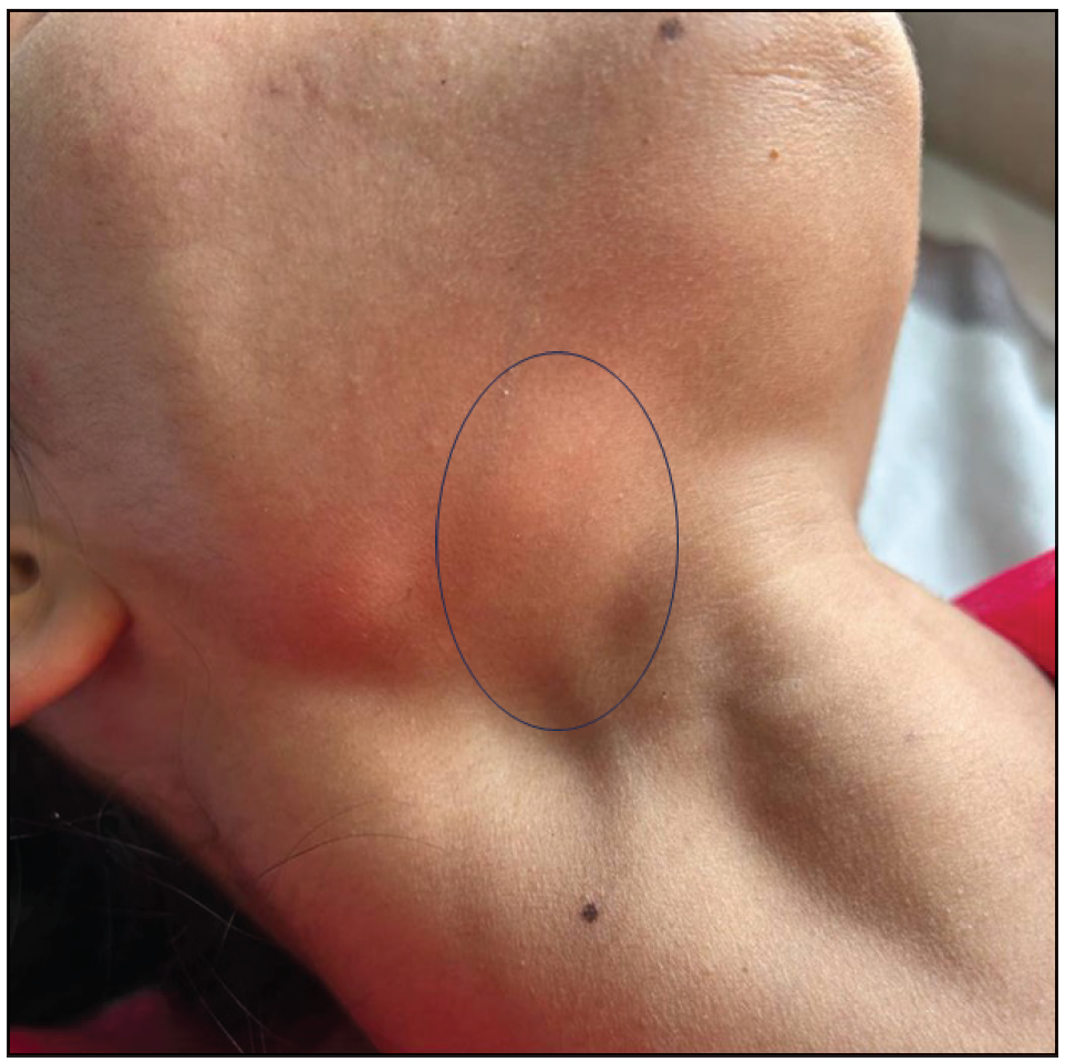 Decrease in the size of the right submandibular cervical lymph node as shown in a black circle.