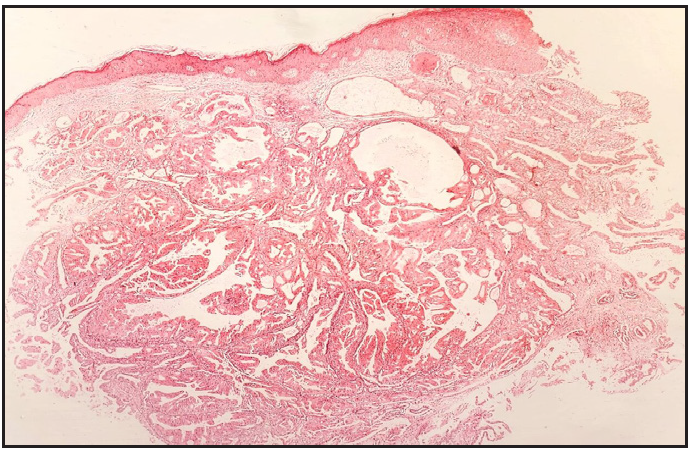 Unremarkable epidermis with dermis showing unencapsulated tumour (Haematoxylin and eosin, 100x).