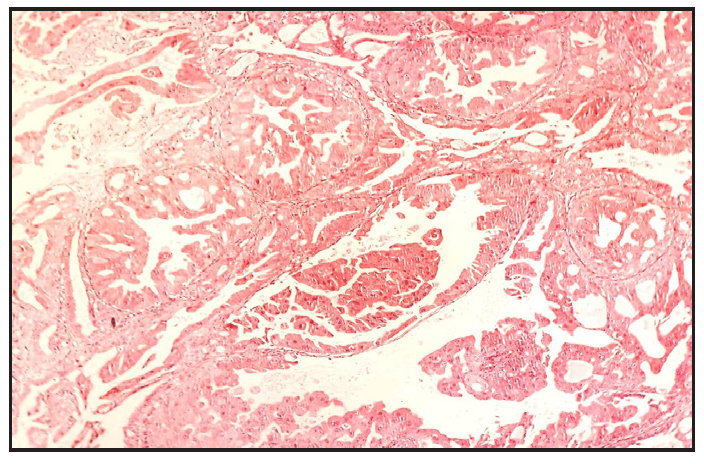 Tumour comprising of cells arranged in glands or ducts with back to back arrangement and scant intervening stroma (Haematoxylin and eosin, 200x).
