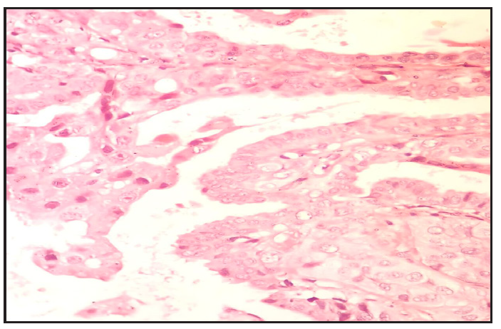 Bilayered ductal epithelium with focal epithelial hyperplasia and short papillary projections (Haematoxylin and eosin, 400x).