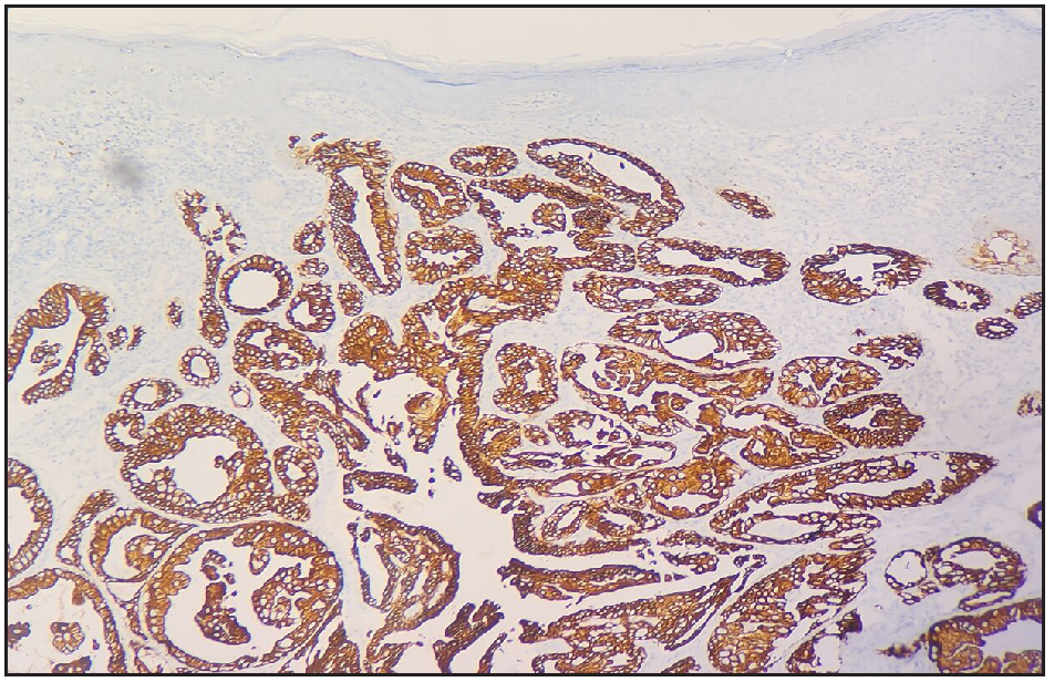 Luminal ductal epithelial cells were positive for CK7 (CK7 immunohistochemistry, 100x).