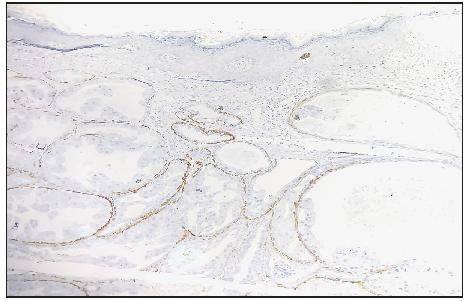 The outer layer of myoepithelial cells was positive for calponin stain (Calponin immunohistochemistry, 100x).