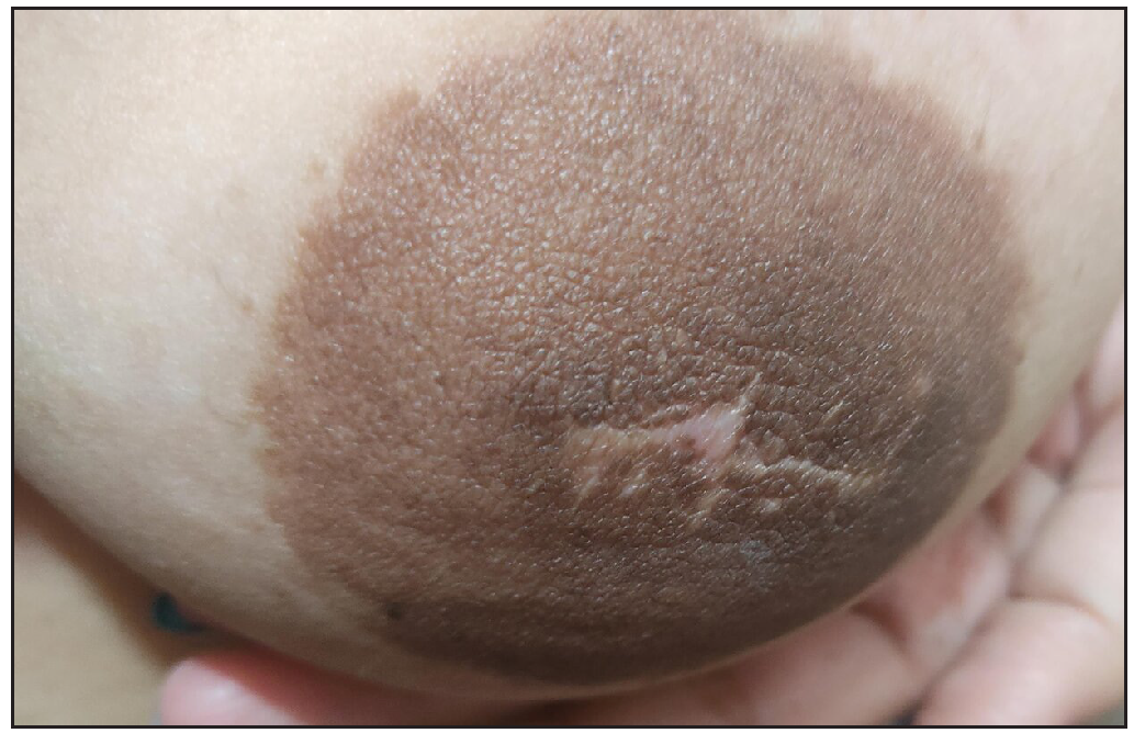 Clinical image after complete excision followed by reconstruction of the left nipple.