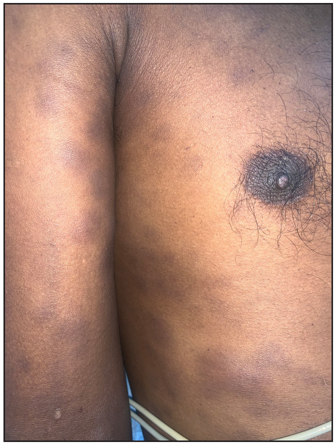 Multiple erythematous tender indurated nodules on the upper limb.