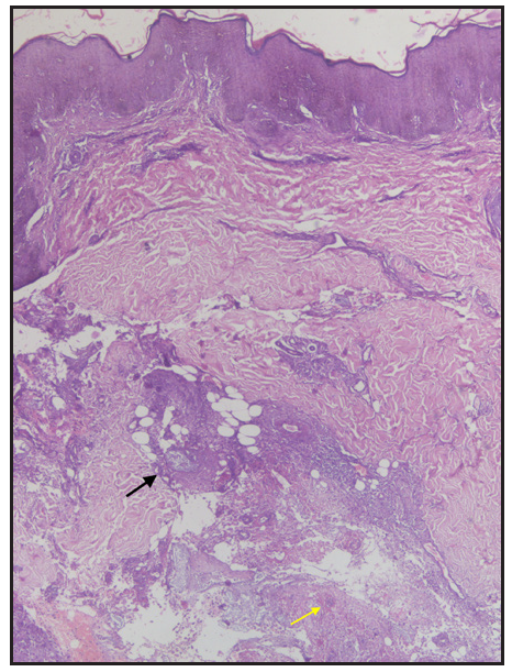 Histopathology showing predominantly lobular panniculitis (Haematoxylin & eosin, 40x). Distortion of lobular architecture in the adipose tissue (black arrow) and ghost-like adipocytes (yellow arrow).
