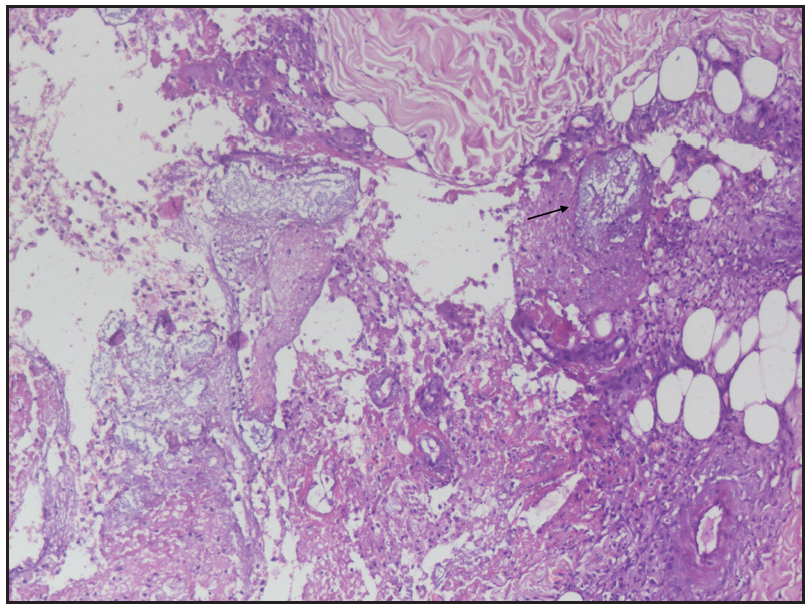 Histopathology showing distortion of lobular architecture and saponification (black arrow) (Haematoxylin & eosin, 100x).