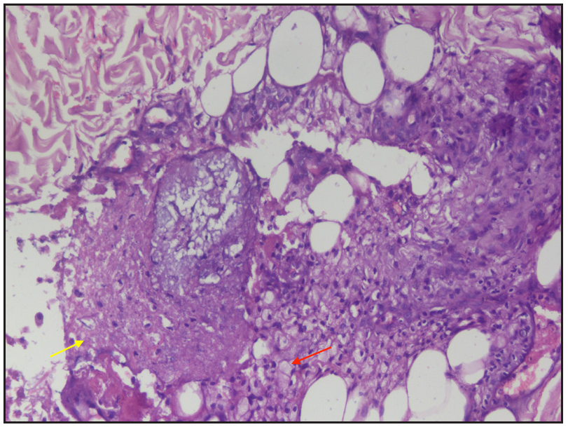 Histopathology showing inflammatory infiltrate composed primarily of foamy macrophages (red arrow) and neutrophils and areas of fat necrosis (yellow arrow) (Haematoxylin & eosin, 200x).