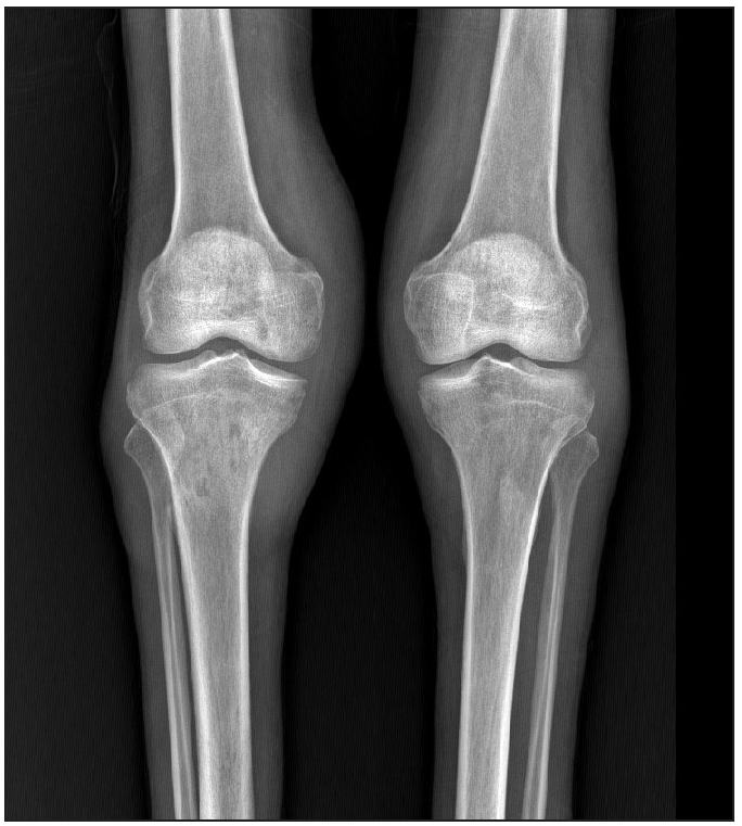 X-ray of bilateral knee joints showing periarticular hypodensities with soft tissue swelling suggestive of osteopenia and osteolytic changes.