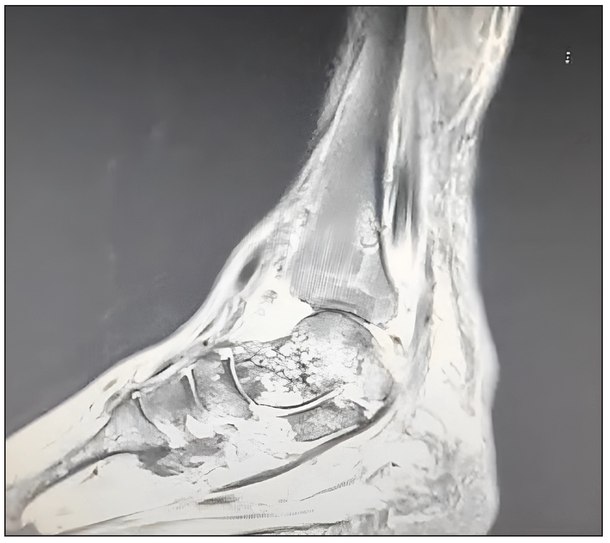 MRI of ankle joint showing multifocal osteonecrosis and periarticular cystic changes.