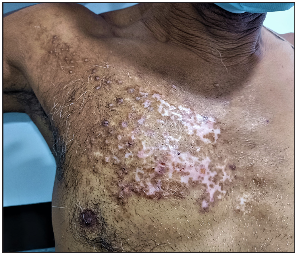 Irregular hypertrichotic, hyperpigmented patch with overlying multiple, excoriated papules and nodules localised to the right side of the chest.
