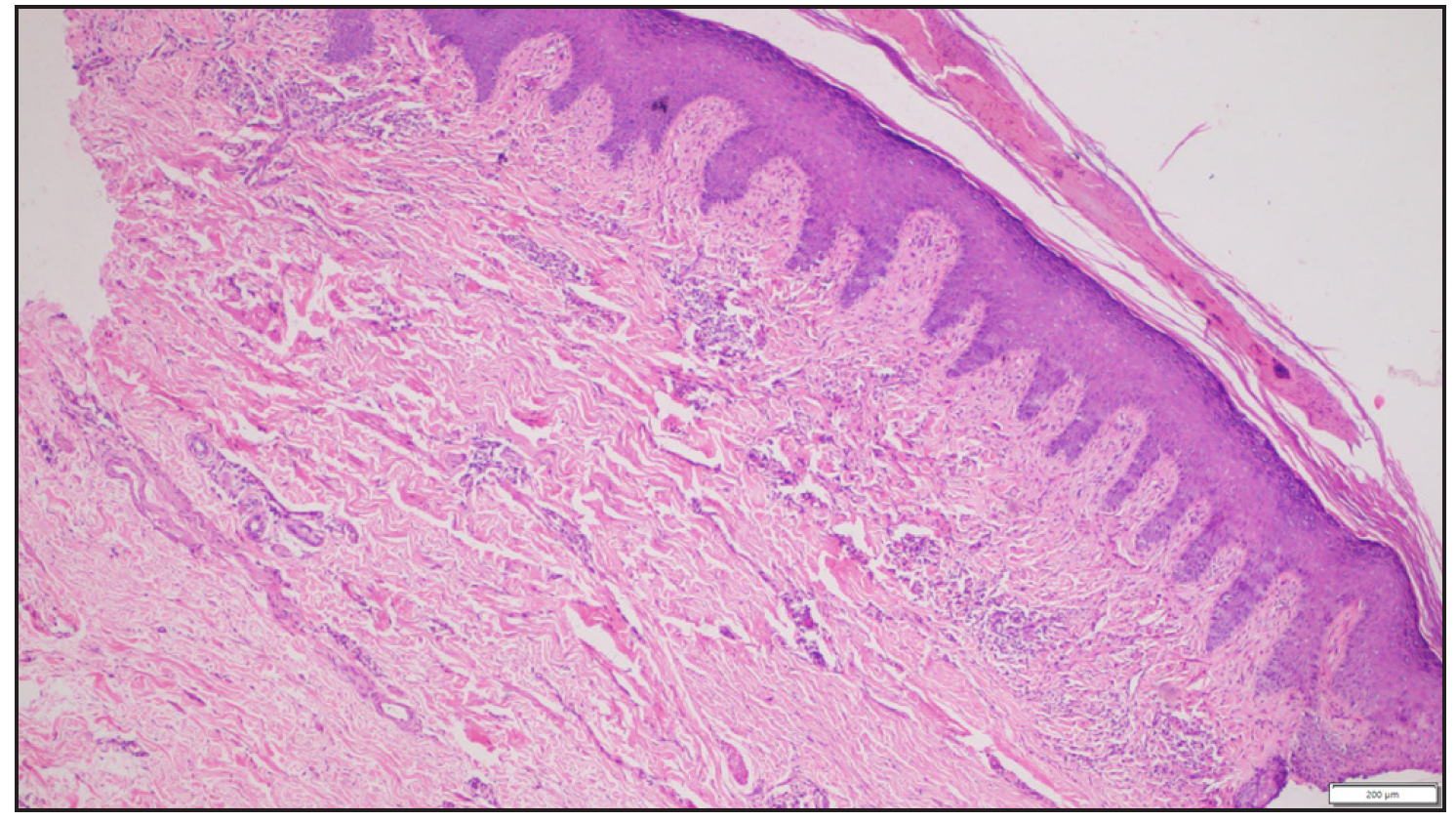 Histopathology showing irregular acanthosis, papillary dermal fibrosis, and mild to moderate perivascular and interstitial infiltrate of lymphocytes and histiocytes (Haematoxylin and eosin, 100x).