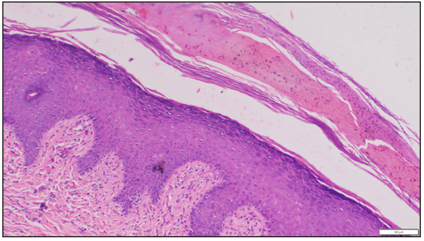 Higher magnification showing irregular acanthosis and papillary dermal fibrosis (Haematoxylin and eosin, 400x).