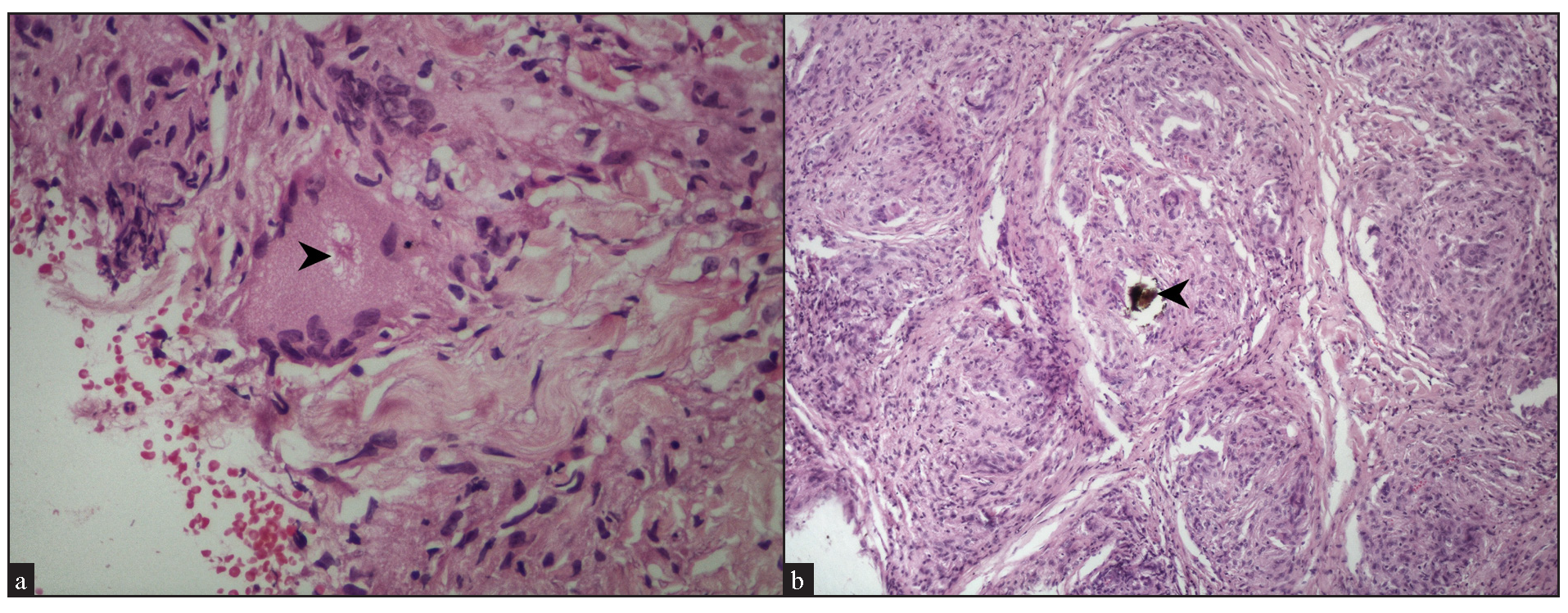 (a) Asteroid body (black arrowhead) within a giant cell (Haematoxylin and eosin, 400x). (b) Schaumann body (black arrowhead) with a giant cell in a sarcoidal granuloma (Haematoxylin and eosin, 100x).